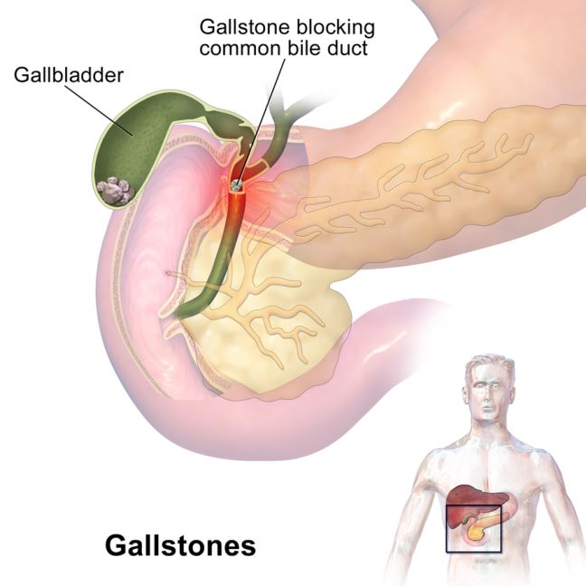 illustration that shows where the gallbladder is located in the human body and zooms in on details such as the stone blocking
bile duct