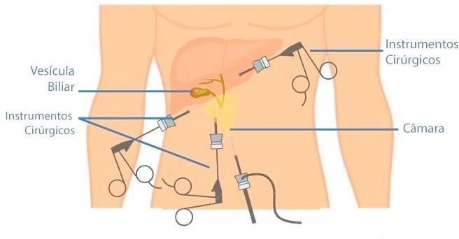 Illustration simulates human body, location of gallbladder and surgical instruments, camera, used during operation